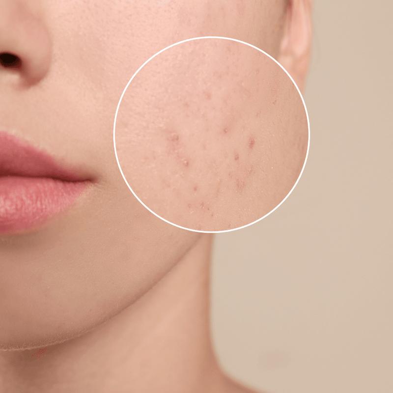 Battling Adult Acne? Try Manuka Honey showing close-up of acne on skin.
